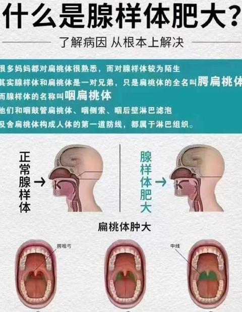 儿童腺样体肥大治疗选择攻略