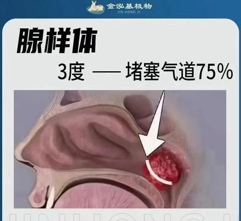 幼儿腺样体肥大阻塞治疗：手术还是保守？