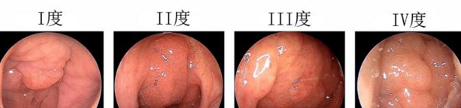 儿童腺样体肥大手术需谨慎考虑