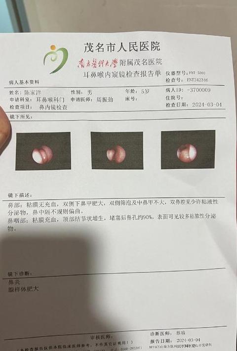 鼻咽癌检查方法全解析：从镜检到活检，一网打尽