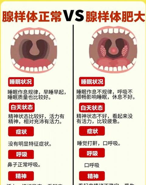 儿童腺样体肥大自愈可能性解析