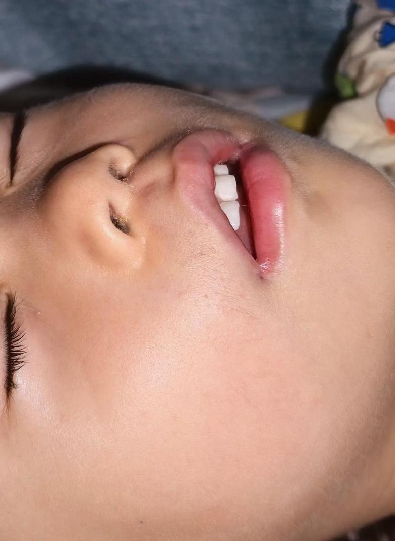 儿童腺样体肥大是否手术？
