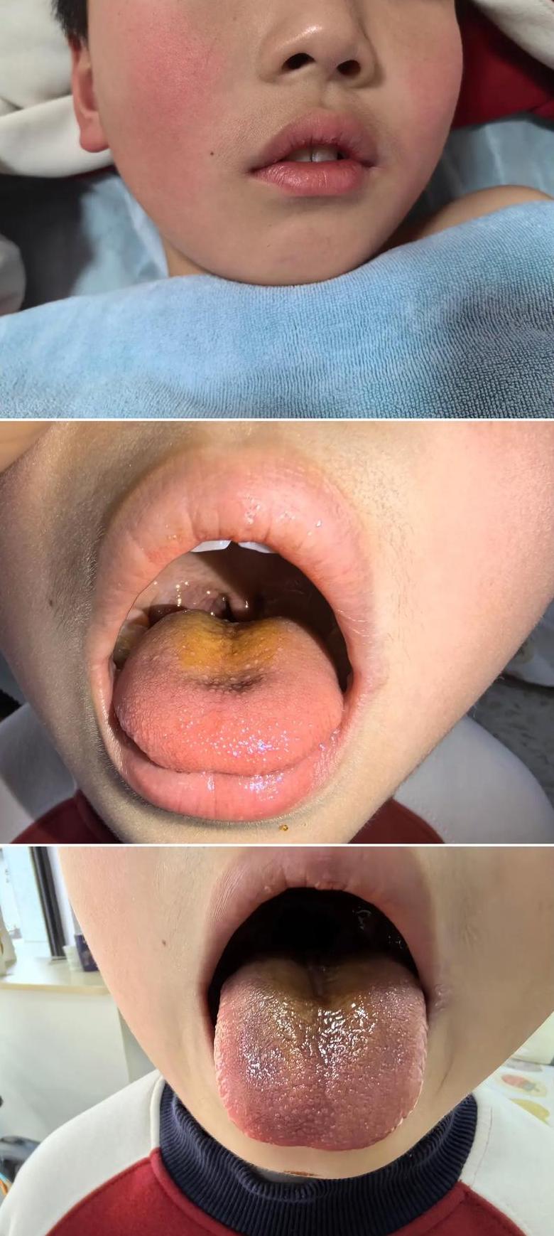 腺样体堵塞90%：药物治疗还是手术切除？