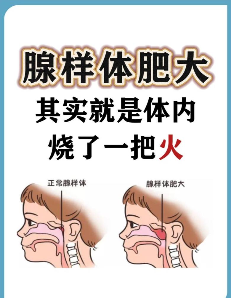 儿童腺样体肥大：症状、治疗与医保解析