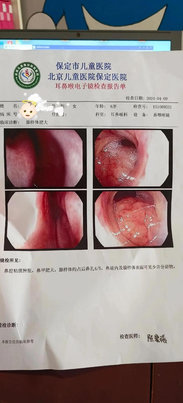 儿童腺样体肥大手术必要性分析