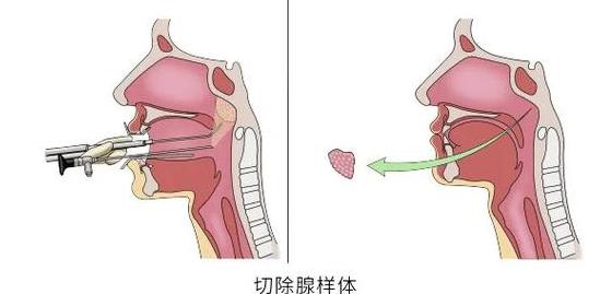 儿童腺样体手术适宜年龄及注意事项
