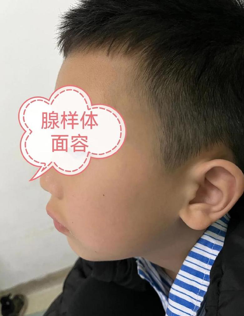 腺样体堵塞2/3，严重程度及治疗建议