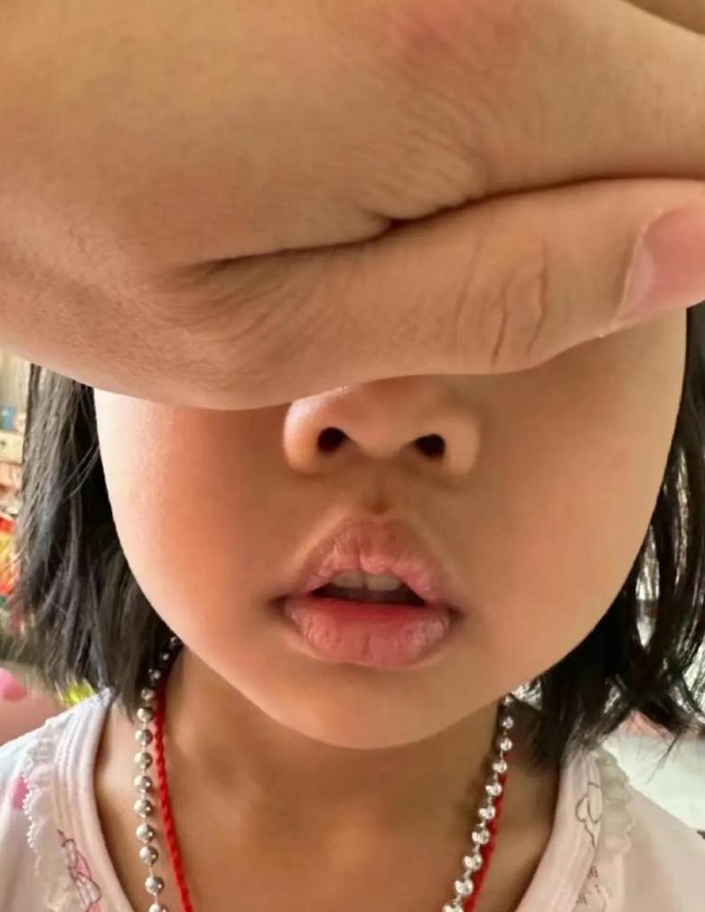 孩子腺样体肥大：手术还是保守治疗？