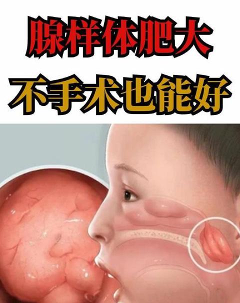 儿童腺样体肥大手术需知指南