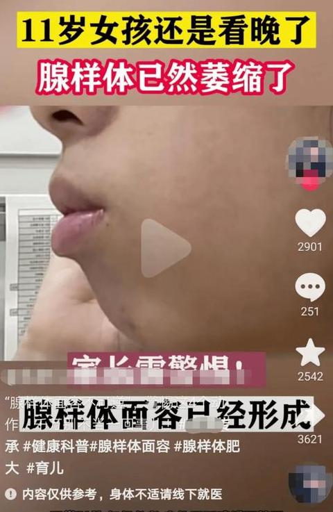 儿童腺样体肥大治疗与手术选择指南